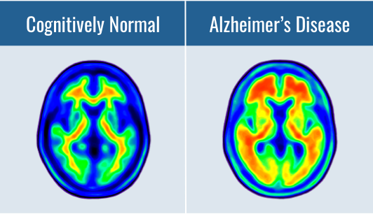 Biomarkers and Alzheimer's Disease: Amyloid Beta, Tau, Others | Identify Alzheimer's Disease - Biogen